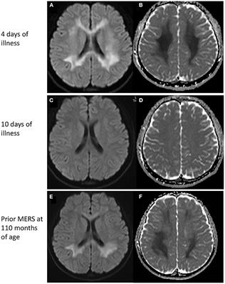 Case report: Mild encephalitis with a reversible splenial lesion associated with SARS-CoV-2 infection in a patient with MYRF variant